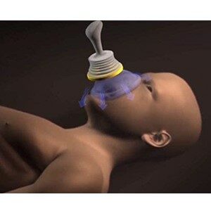 How To Use The LifeVac Device