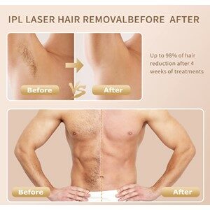 IPL Before and After Results